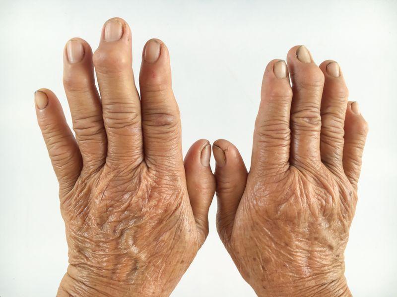 артрит у бабушки